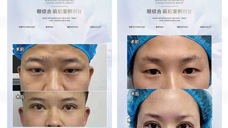 超声炮美容设备，揭秘其适合人群与优势