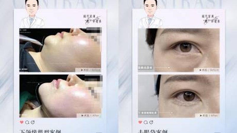 重庆面部轮廓整形恢复期揭秘：了解真实恢复过程