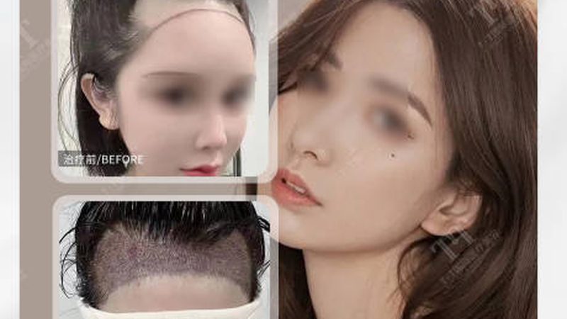 北京激光脱毛前后对比：揭秘真实效果与注意事项