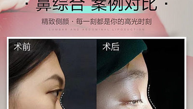 激光祛斑恢复期要多久？揭秘祛斑后的真实恢复过程