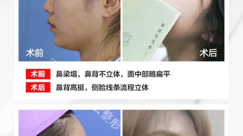 家用光子嫩肤仪代理渠道：揭秘行业“幕后