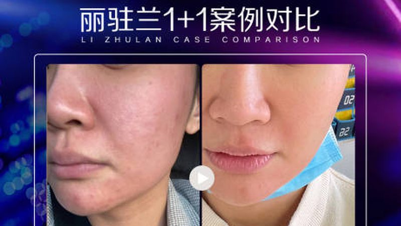 打了瘦脸针又长回来，是反弹还是你想错了