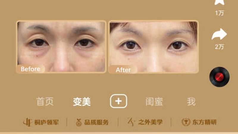 激光祛斑黄褐斑反弹概率高吗？揭秘激光祛斑的真相