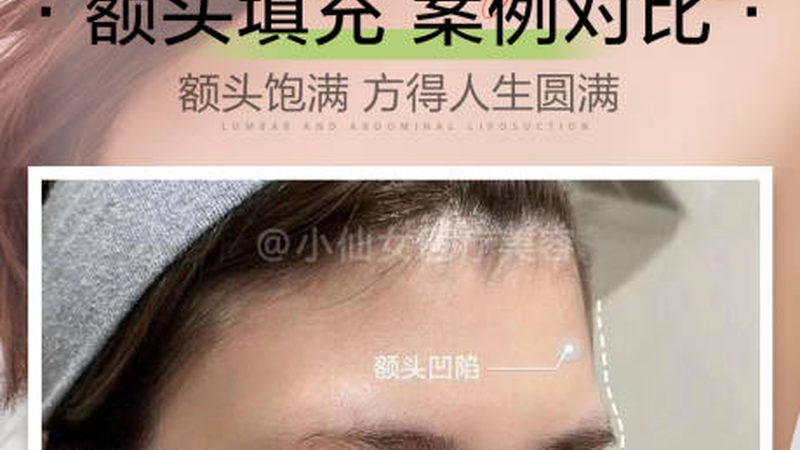 哪种注射美容维持时间最长